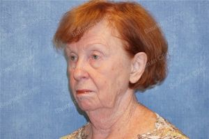 Căng da mặt, khách hàng nữ 69 tuổi Hoa Kỳ - case 7