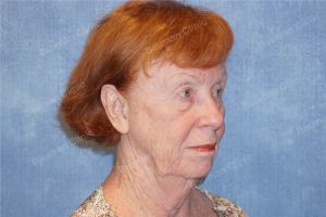 Căng da mặt, khách hàng nữ 69 tuổi Hoa Kỳ - case 7