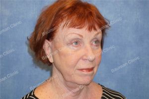 Căng da mặt, khách hàng nữ 69 tuổi Hoa Kỳ - case 7