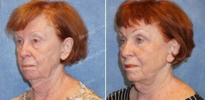 Căng da mặt, khách hàng nữ 69 tuổi Hoa Kỳ - case 7