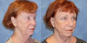 Căng da mặt, khách hàng nữ 69 tuổi Hoa Kỳ - case 7
