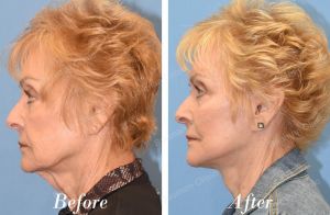 Căng da mặt sau 6 tháng - case 70