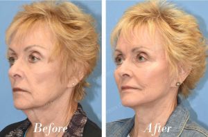 Căng da mặt sau 6 tháng - case 70