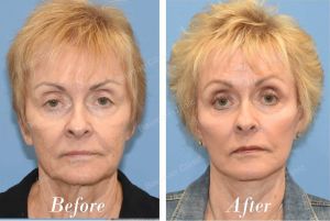 Căng da mặt sau 6 tháng - case 70