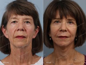 Căng da mặt nữ 71 tuổi - case 71