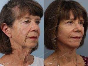 Căng da mặt nữ 71 tuổi - case 71