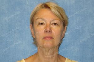 Căng da mặt khách hàng người Mỹ 55 tuổi - case 8