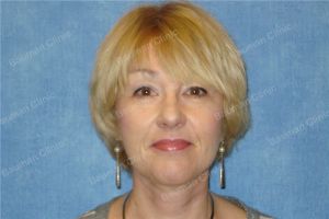 Căng da mặt khách hàng người Mỹ 55 tuổi - case 8