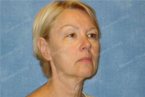 Căng da mặt khách hàng người Mỹ 55 tuổi - case 8