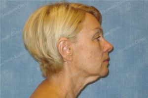 Căng da mặt khách hàng người Mỹ 55 tuổi - case 8