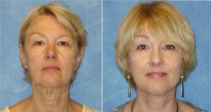 Căng da mặt khách hàng người Mỹ 55 tuổi - case 8