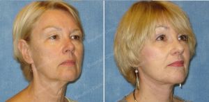 Căng da mặt khách hàng người Mỹ 55 tuổi - case 8