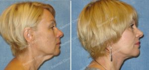 Căng da mặt khách hàng người Mỹ 55 tuổi - case 8