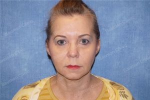 Căng da mặt nữ 54 tuổi người Mỹ - case 9