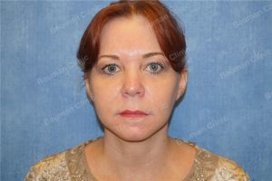 Căng da mặt nữ 54 tuổi người Mỹ - case 9