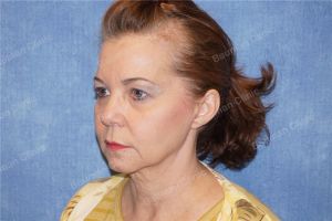 Căng da mặt nữ 54 tuổi người Mỹ - case 9