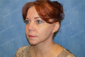 Căng da mặt nữ 54 tuổi người Mỹ - case 9