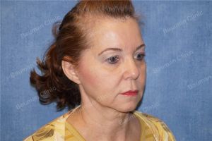 Căng da mặt nữ 54 tuổi người Mỹ - case 9