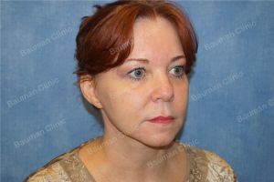 Căng da mặt nữ 54 tuổi người Mỹ - case 9