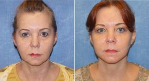 Căng da mặt nữ 54 tuổi người Mỹ - case 9