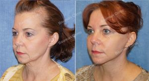 Căng da mặt nữ 54 tuổi người Mỹ - case 9