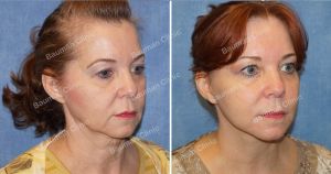 Căng da mặt nữ 54 tuổi người Mỹ - case 9