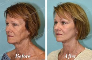 Căng da mặt - case 63