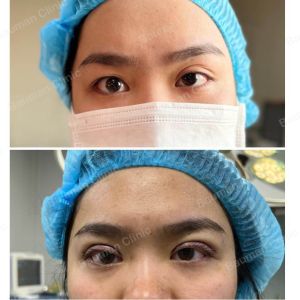 Hạ mí trợn siêu khó - case 1