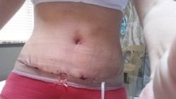 Tôi đã bị tụ máu sau Combo ngực bụng, có nên rút ống dẫn lưu lúc này hay không?