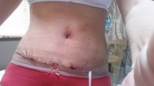 Tôi đã bị tụ máu sau Combo ngực bụng, có nên rút ống dẫn lưu lúc này hay không?