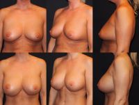 Tôi bị lồi đáy vú hay là gò ngực kép?
