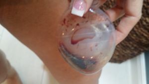 Tôi đã bị tụ máu sau Combo ngực bụng, có nên rút ống dẫn lưu lúc này hay không?