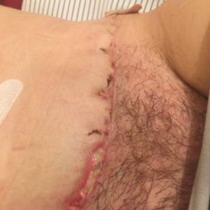 Tôi đang bị nhiễm trùng hay chỉ là phồng rộp?