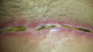 Bốn tuần sau phẫu thuật mà vết thương vẫn chưa khép miệng và có những chỗ bị đen?