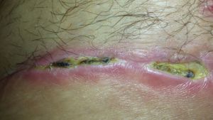 Bốn tuần sau phẫu thuật mà vết thương vẫn chưa khép miệng và có những chỗ bị đen?