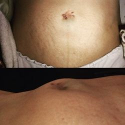 Tôi phải làm gì để chữa rốn biến dạng sau phẫu thuật và xỏ khuyên?