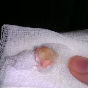 Ba tháng sau combo ngực bụng, vết mổ của tôi có bình thường không?