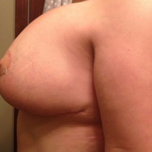 Tôi đã làm combo ngực bụng 6 tuần trước, tôi đã bị co thắt bao xơ rồi đúng không?