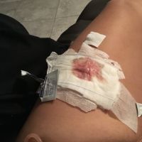 Rốn và vết mổ tạo hình thành bụng bị nhiễm trùng?