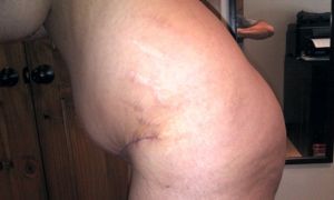 Tại sao một bên bụng và bụng bị phình sau combo ngực bụng?