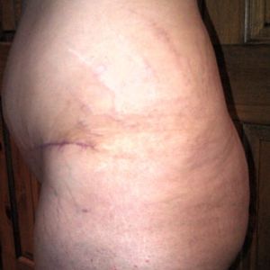 Tại sao một bên bụng và bụng bị phình sau combo ngực bụng?