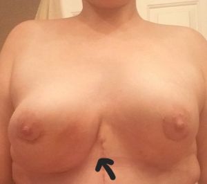 Trông kết quả của tôi 17 ngày sau combo ngực bụng có bình thường không?