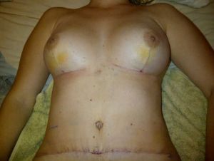 Xuất hiện cục lồi bên dưới cơ hoành sau tạo hình thành bụng?