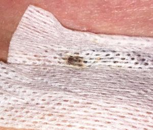 Vết rạch ở ngực của tôi liệu có cần kháng sinh không?