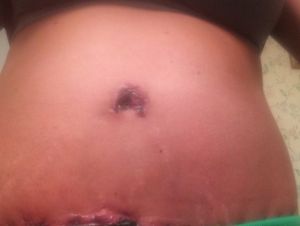 Rốn của tôi trông thật kinh khủng 5 ngày sau phẫu thuật, có phải đã bị hoại tử rồi không?