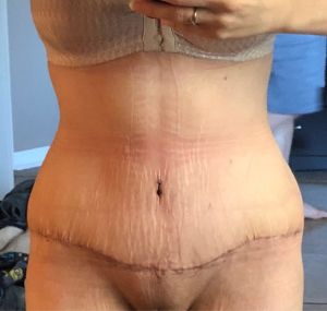 Tại sao trông tôi không giống như lúc mới làm phẫu thuật combo ngực bụng?