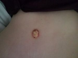 Rốn tôi cứ mãi lồi ra như thế này hay sao?