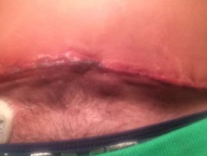 Rốn của tôi trông thật kinh khủng 5 ngày sau phẫu thuật, có phải đã bị hoại tử rồi không?