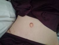 Rốn tôi cứ mãi lồi ra như thế này hay sao?