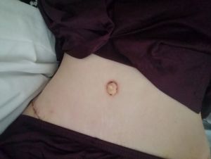 Rốn tôi cứ mãi lồi ra như thế này hay sao?